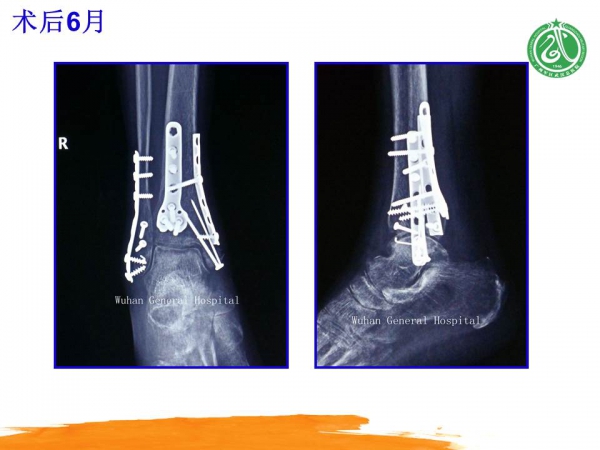 改良后内侧入路治疗胫骨后pilon骨折