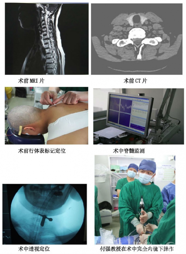 颈椎病治疗的新常态—微创经皮脊柱内镜技术