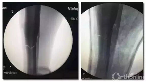 手法复位后片.jpg