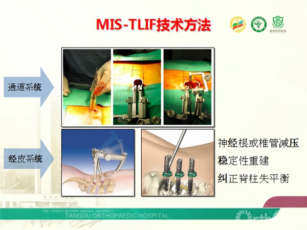 MIS-TLIF治疗腰椎滑脱症的策略及并发症0002_副本.jpg