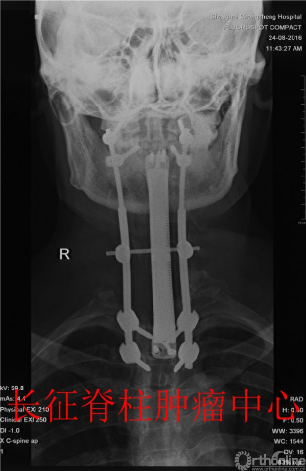 术后X-Ray 高清.jpg