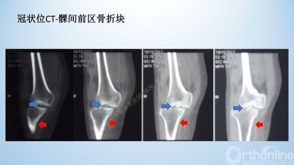 2017-膝关节脱位-病例分享-骨科在线jpg_Page7.jpg