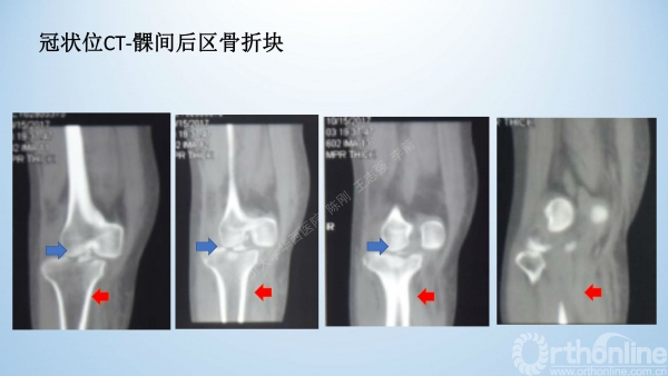 2017-膝关节脱位-病例分享-骨科在线jpg_Page8.jpg