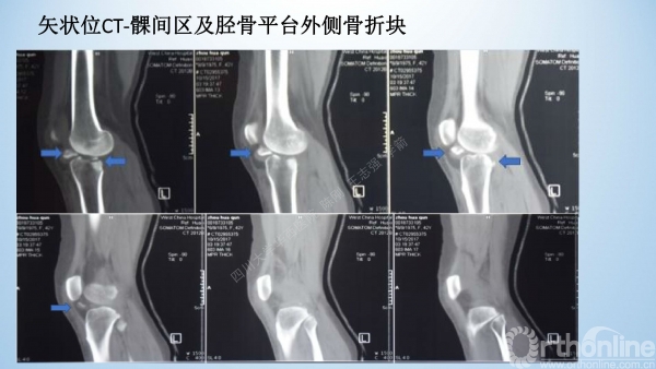 2017-膝关节脱位-病例分享-骨科在线jpg_Page10.jpg