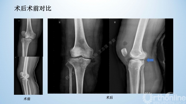 2017-膝关节脱位-病例分享-骨科在线jpg_Page30.jpg