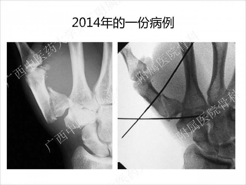 辅助中国笼牵引指套经皮1238jpg_Page4.jpg