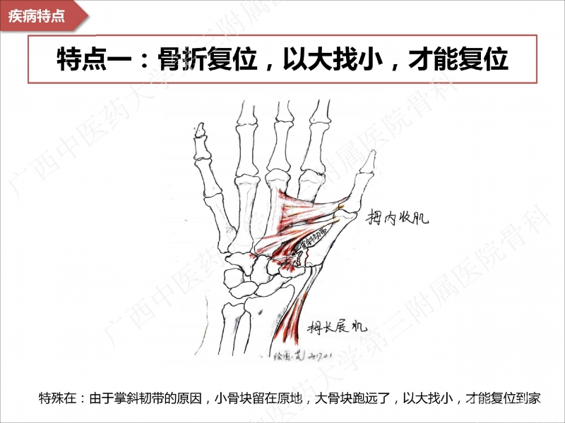 辅助中国笼牵引指套经皮1238jpg_Page6.jpg