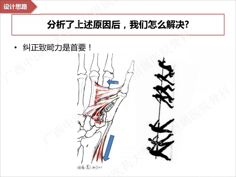 辅助中国笼牵引指套经皮1238jpg_Page8.jpg
