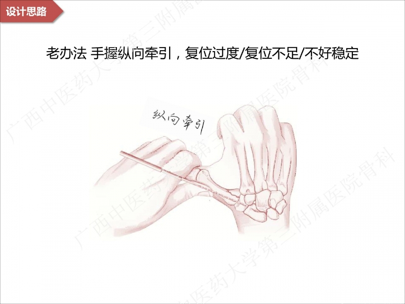辅助中国笼牵引指套经皮1238jpg_Page9.jpg