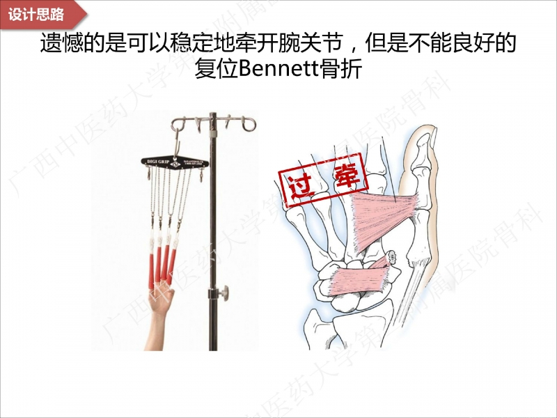 辅助中国笼牵引指套经皮1238jpg_Page14.jpg