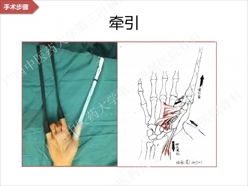 辅助中国笼牵引指套经皮1238jpg_Page19.jpg