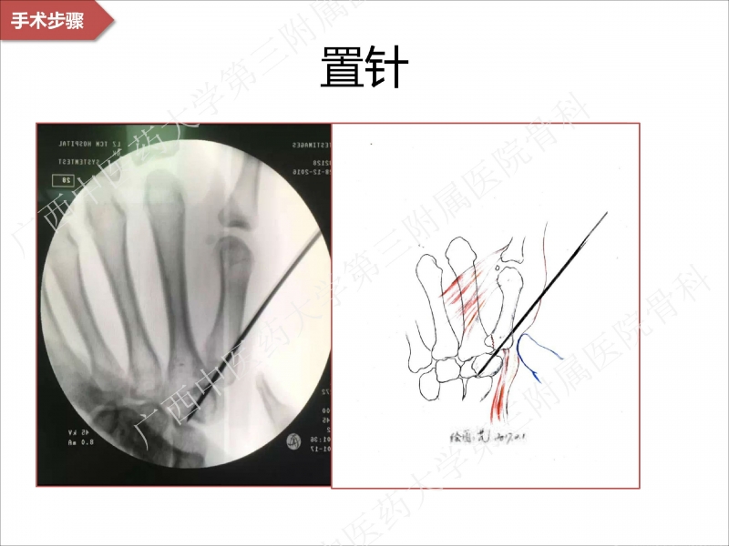辅助中国笼牵引指套经皮1238jpg_Page20.jpg