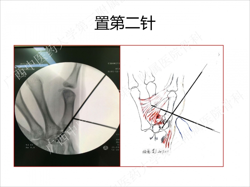 辅助中国笼牵引指套经皮1238jpg_Page21.jpg