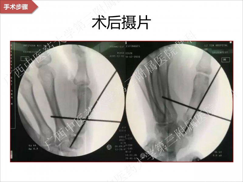 辅助中国笼牵引指套经皮1238jpg_Page22.jpg