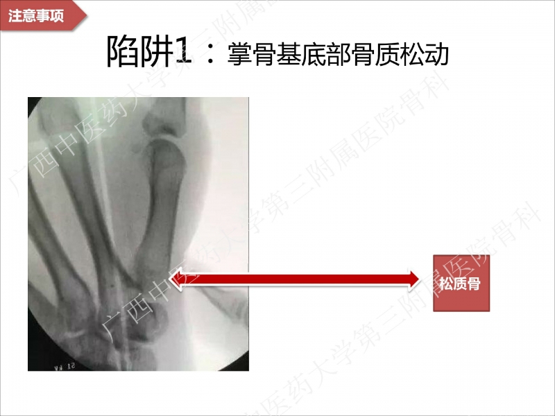 辅助中国笼牵引指套经皮1238jpg_Page23.jpg