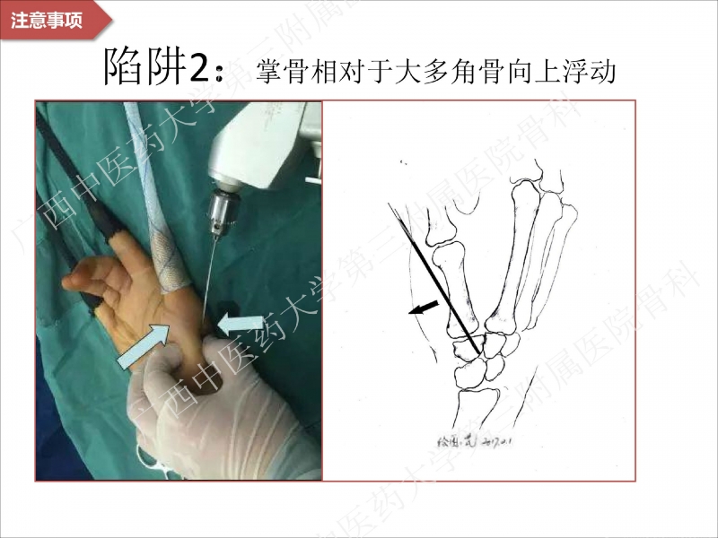 辅助中国笼牵引指套经皮1238jpg_Page26.jpg