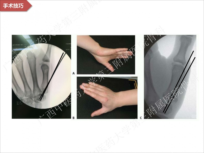 辅助中国笼牵引指套经皮1238jpg_Page27.jpg