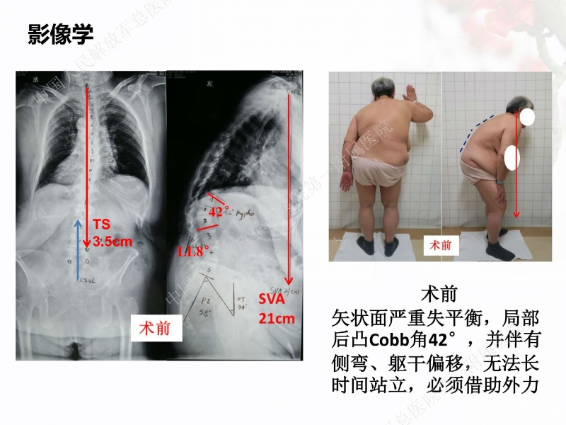 马超医师-老年性脊柱后凸的手术治疗(原版)jpg_Page5.jpg