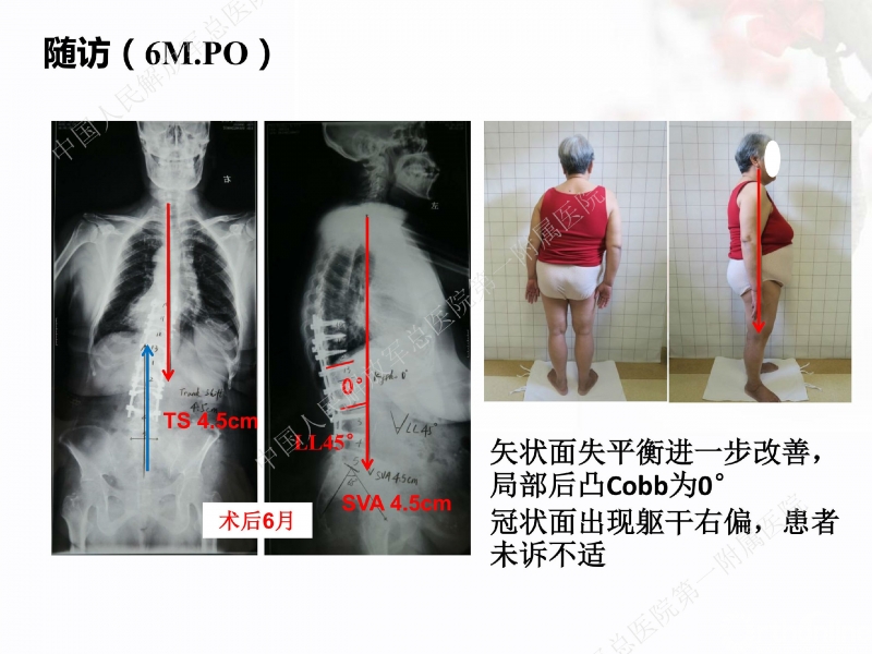 马超医师-老年性脊柱后凸的手术治疗(原版)jpg_Page8.jpg