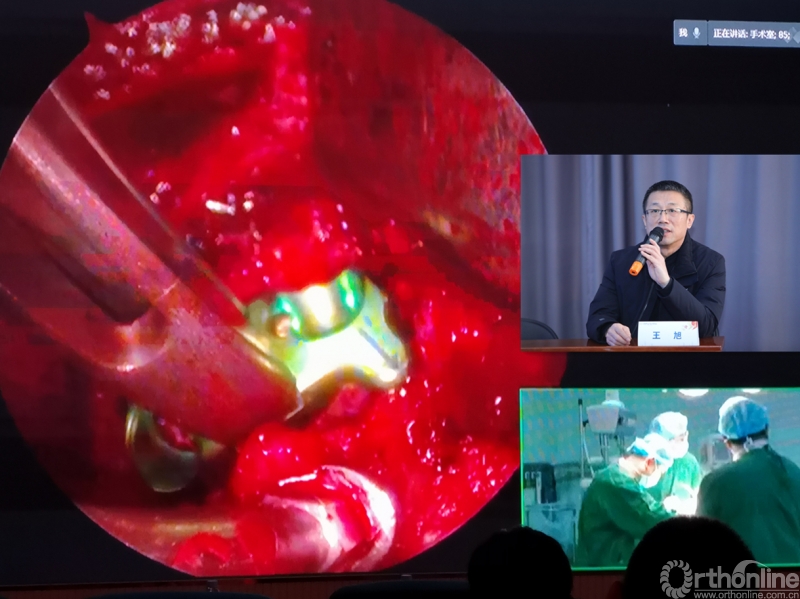 王旭实时讲解丁文元手术.jpg