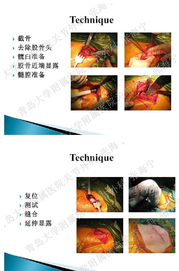 比基尼入路微创人工全髋关节置换术_页面_08.png