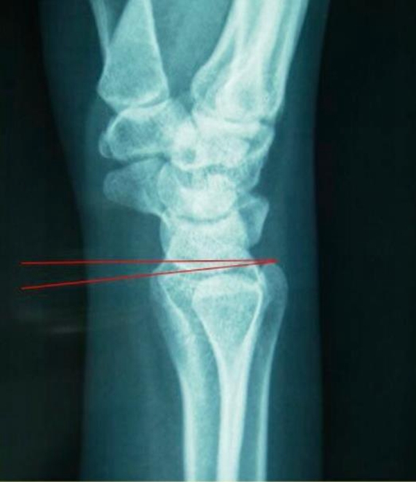 桡骨远端骨折闭合复位固定技术| 骨科在线手机版
