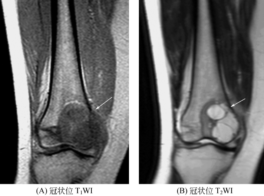 临床必备：骨肿瘤和肿瘤样病变的MRI诊断（上） | 骨科在线手机版